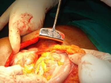 Laparotomy in patient with intestinal obstruction.