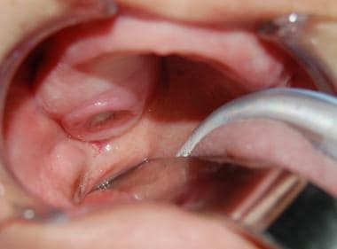 hard palate