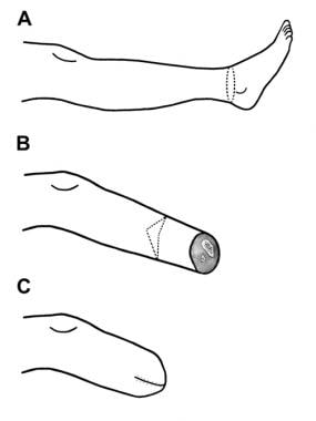 Guillotine amputation. Illustration shows level of