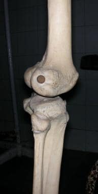 Knee, as seen from side. 