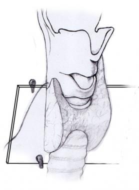 Recurrent laryngeal nerve and parathyroid relation