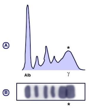 Polyclonal pattern serum protein electrophoresis (