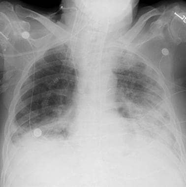 This patient had a left pneumothorax with placemen