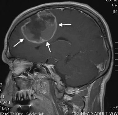 Brain abscess. Sagittal contrast-enhanced T1 MRI. 