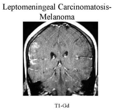 Coronal contrast-enhanced MRI of a patient with kn