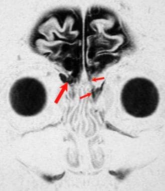 Acute posttraumatic cerebrospinal fluid rhinorrhea
