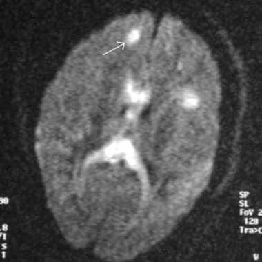 Magnetic resonance imaging diffusion sequence demo