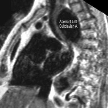Parasagittal T1-weighted MRI of the chest (obtaine
