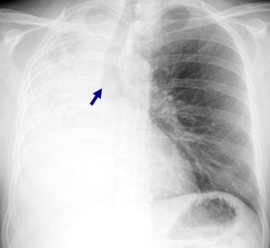 Posteroanterior chest radiograph in a 54-year-old 