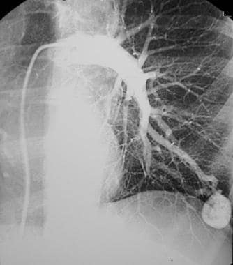 Pulmonary angiogram confirms a large pulmonary art