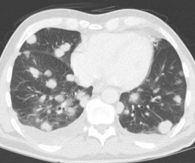 Axial CT scan in a 58-year-old man with malignant 
