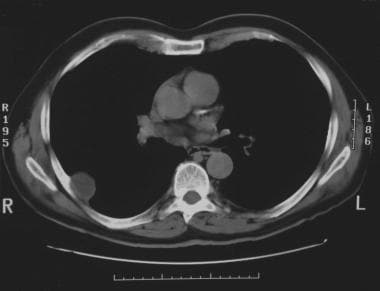 Solitary pulmonary nodule. CT scan of the chest sh