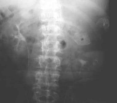 Intravenous urogram performed in a 64-year-old man