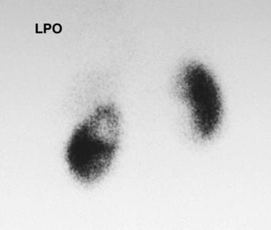 Left posterior view of a technetium-99m dimercapto