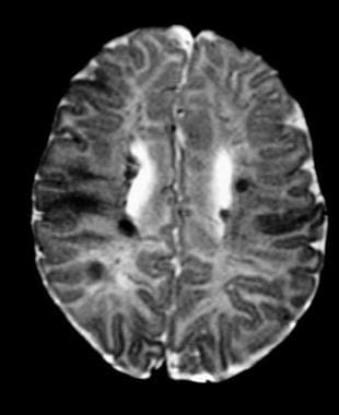 Axial T2-weighted MRI in an infant with tuberous s