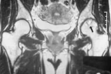 Coronal T1-weighted magnetic resonance image (MRI)