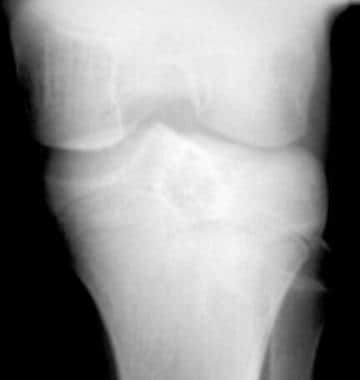 Plain radiograph of the proximal tibia in a 14-yea