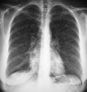 Chest radiograph in a 30-year-old woman who presen