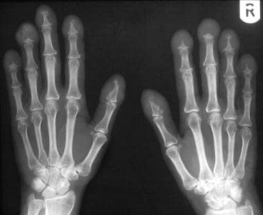 Radiograph of both hands in a 42-year-old man with