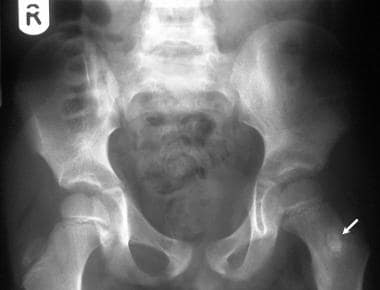 Plain radiograph of the pelvis in a 6-year-old chi