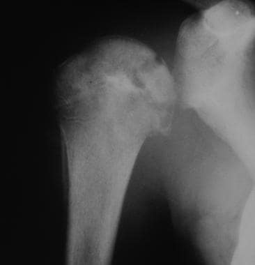 Septic arthritis. Anteroposterior view of the shou