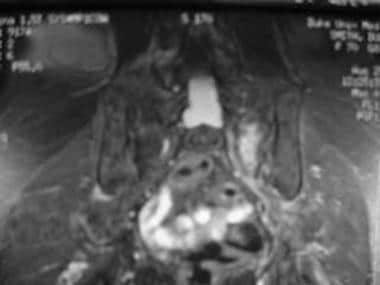 The acute stress fracture in the left sacrum appea