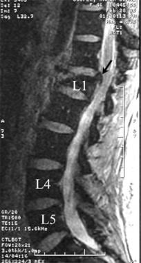 Lumbar spine trauma. Sagittal T2-weighted gradient