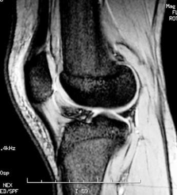 Extensor mechanism injuries of the knee. A 19-year