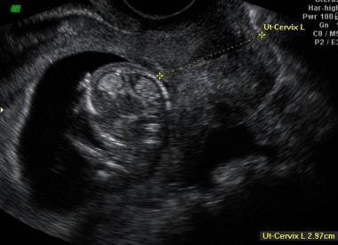 Cervical Incompetence Imaging Practice Essentials Magnetic