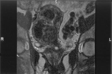 Coronal T2-weighted MRI shows an enlarged uterus w