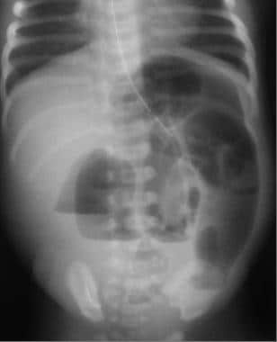 Ileal atresia. Upright radiograph of the abdomen d