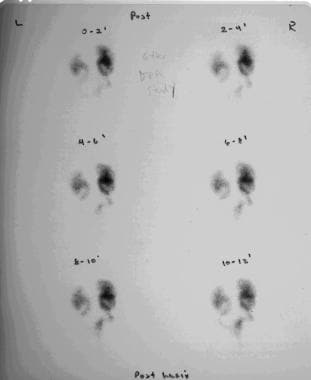 Excretory images obtained from renal scanning that