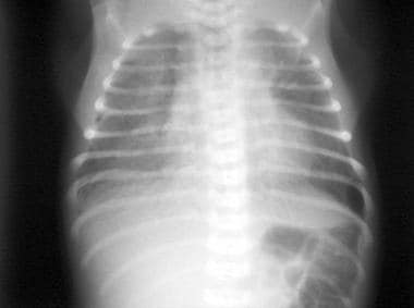 Transient tachypnea of the newborn. Radiograph of 