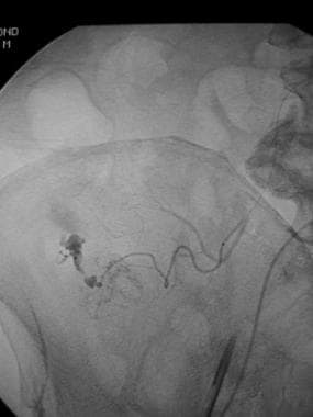 Selective arteriogram through a microcatheter furt