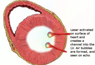 Channels created by transmyocardial laser revascul