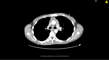 CT scan of the thorax with intravenous contrast of