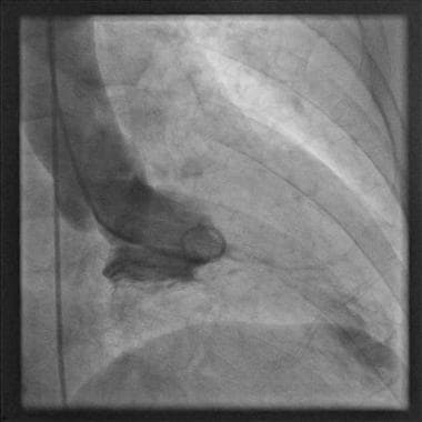 Left ventriculogram showing mid cavity obliteratio