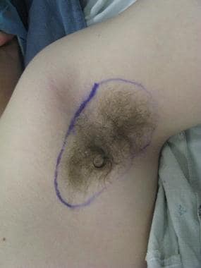 The hair bearing skin of the patient's axilla is m