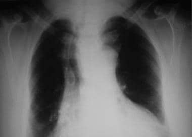 Chest radiograph of substernal goiter with trachea