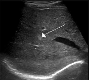 Hemangioma of the liver as seen on ultrasound. Cou