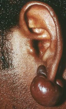 Keloid. Courtesy of Dirk M. Elston, MD. 