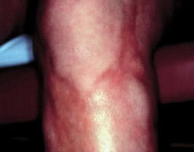 Deep morphea involving the left lower extremity, w
