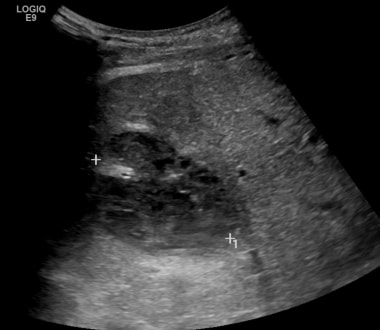 C-6: Ultrasound image of the same patient showing 