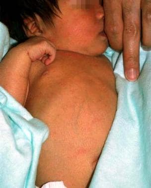 A 5-day-old newborn with erythematous papules with