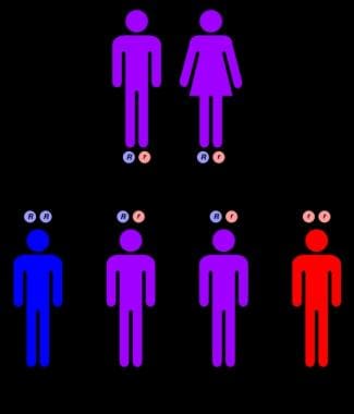 Bone marrow involvement in Niemann Pick disease - 1.