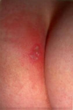 Herpes genital que data