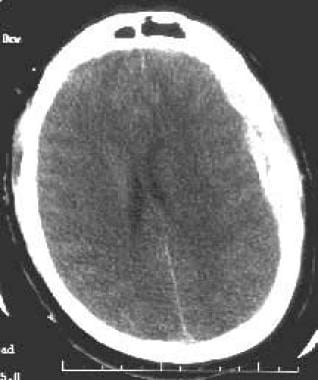 A left-sided acute subdural hematoma (SDH). Note t