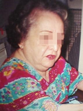 一位69岁的女性患有斜颈