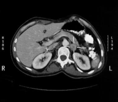 Left Adrenal Gland Adenoma