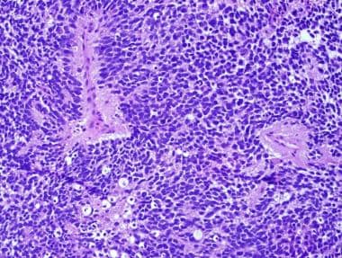 Pathology of Embryonal Tumors. On this histologic 